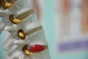 bulging disc treatment