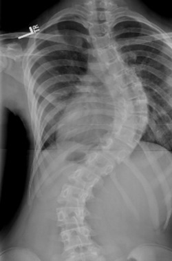 scoliosis chiropractic care