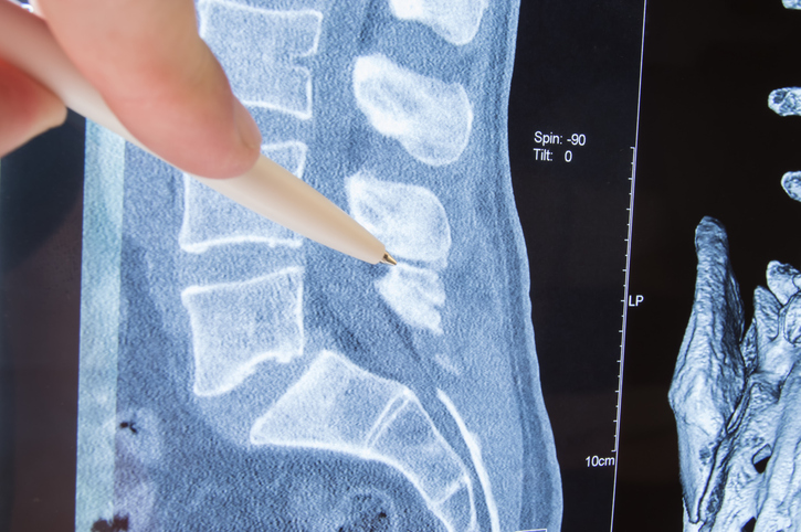 Photo MRI lumbosacral spine pathology. Radiologist indicated on possible pathology or disease of image of spine lumbosacral MRI such as sciatica, protrusion of disc, pinched nerve, hernia, stenosis sciatica cause