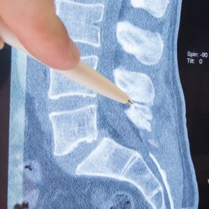 memorial city herniated disc treatment