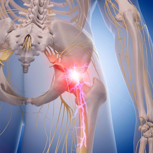 greenwayplazasciatica greenway plaza sciatica treatment
